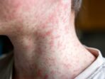 Delaware Reports First Measles Case in Over 10 Years, Health Officials Launch Contact Tracing Delaware Reports First Measles Case in Over 10 Years, Health Officials Launch Contact Tracing