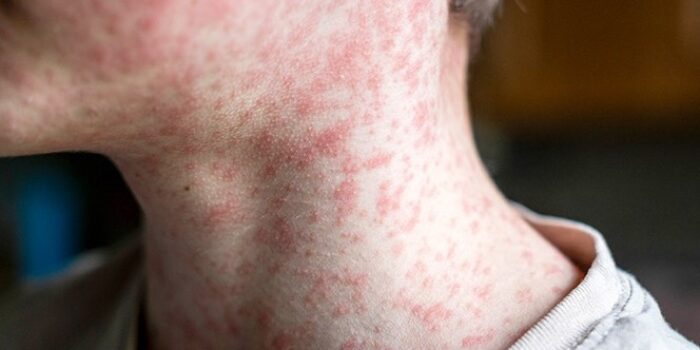 Delaware Reports First Measles Case in Over 10 Years, Health Officials Launch Contact Tracing Delaware Reports First Measles Case in Over 10 Years, Health Officials Launch Contact Tracing
