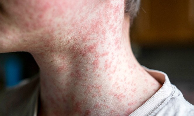 Delaware Reports First Measles Case in Over 10 Years, Health Officials Launch Contact Tracing
